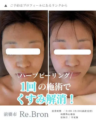 毛穴ケア くすみ肌 ハーブピーリングのエステ・リラクイメージ