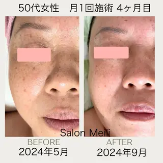 ピーリングケア 🤍moekoのその他イメージ