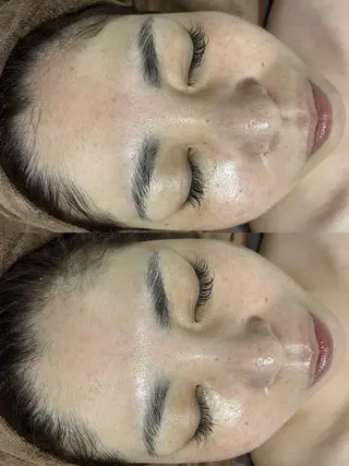 ニキビ／毛穴ケア ハーブピーリングのエステ・リラクイメージ