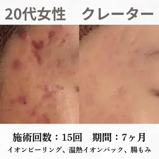 重度ニキビ専門🌷 ダウンタイムなしのエステ・リラクイメージ
