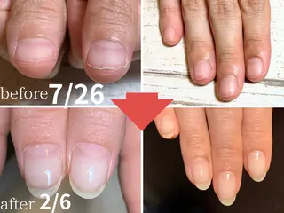 ネイル 深爪矯正・自爪育成 ネイルサロンアモここのネイルデザイン