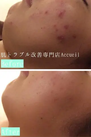 3か月で肌革命👼 ニキビ専門店💫のエステ・リラクイメージ