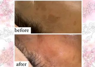 【ハーブピーリング】 Allumentのエステ・リラクイメージ