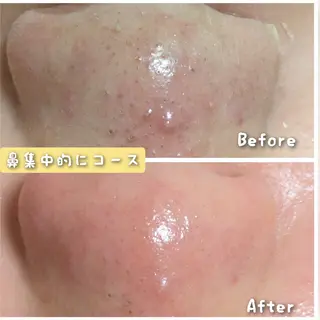 結果が出るスキンケア 肌質改善/まつパのエステ・リラクイメージ