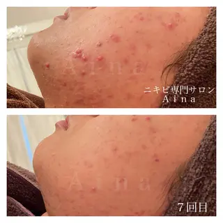 セミロング パーマ ヘアアレンジ メンズ キッズ ネイル マツエク・マツパ ニキビ跡専門サロン Ainaのエステ・リラクイメージ
