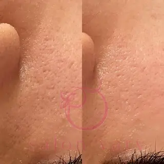 【ニキビ/肌管理】 salon varyのエステ・リラクイメージ