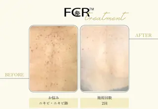 美容鍼灸/小顔鍼灸 肌質改善エステのエステ・リラクイメージ