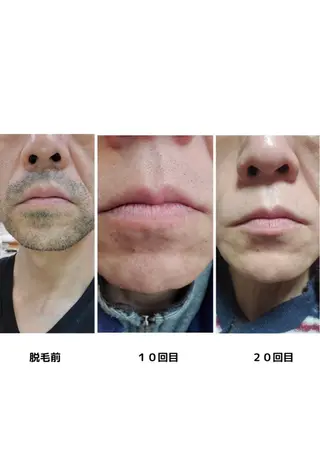 全身脱毛/韓国ツヤ肌 ハーブピーリングのエステ・リラクイメージ