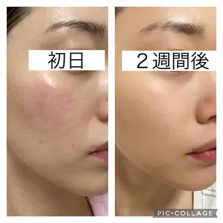 韓国肌管理ララピール 小顔リフト/LDMのエステ・リラクイメージ