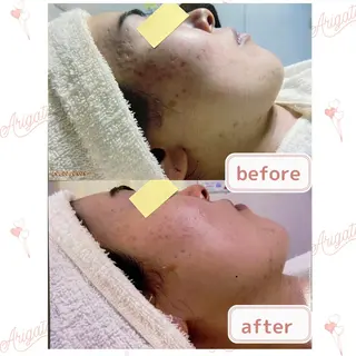 ニキビケア◇ニキビ跡 レゾン京橋店　八崎のエステ・リラクイメージ