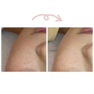 ニキビ/敏感肌/乾燥 Lilyauraのエステ・リラクイメージ