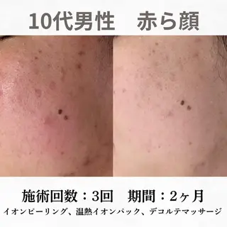重度ニキビ専門🌷 ダウンタイムなしのエステ・リラクイメージ