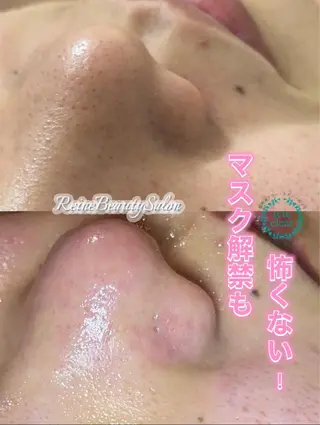 毛穴/シミ肝斑/脱毛 横山梨里のエステ・リラクイメージ