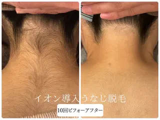 🎀うなじ脱毛🎀 ㅣLino堀江のエステ・リラクイメージ