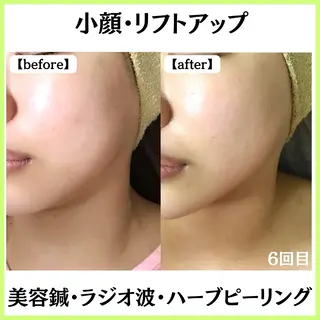小顔ハーブピーリング 美容鍼/毛穴洗浄のエステ・リラクイメージ
