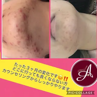 ミディアム カラー パーマ ヘアアレンジ メンズ ネイル マツエク・マツパ ニキビ・肌質改善専門 ♡人生が変わるサロンのエステ・リラクイメージ