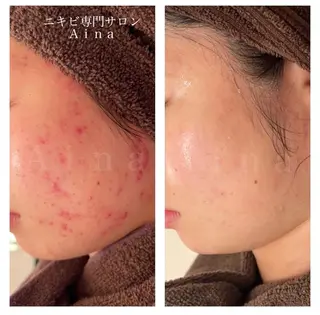 カラー パーマ ヘアアレンジ メンズ キッズ ネイル マツエク・マツパ アイブロウ ニキビ跡専門サロン Ainaのエステ・リラクイメージ