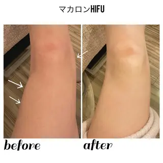 【ニキビ/肌管理】 salon varyのエステ・リラクイメージ