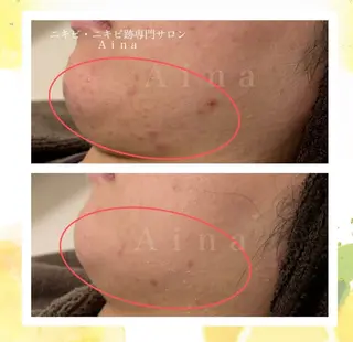 ニキビ跡専門サロン Ａｉｎａのエステ・リラクイメージ