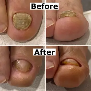 ネイル Mellow nail所属・巻爪無料モデル募集 ✨🦶MEGUMIのネイルデザイン