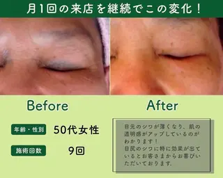 水光韓国肌ハーブ ピーリングMplusのエステ・リラクイメージ