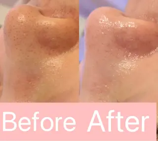 小顔&毛穴・肌質改善 LINDA西宮 AIのその他イメージ