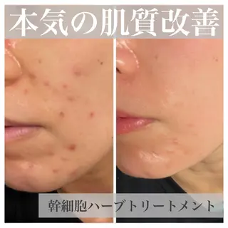 深層筋×筋膜リリース 首肩こり/むくみのエステ・リラクイメージ