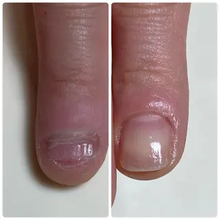 ネイル Nail ビ爪のネイルデザイン
