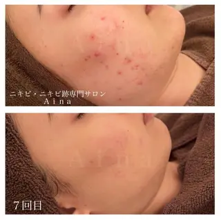 ロング カラー ヘアアレンジ メンズ キッズ ネイル マツエク・マツパ アイブロウ ニキビ跡専門サロン Ainaのエステ・リラクイメージ