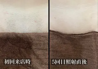 毛穴改善/脱毛 ネイル　川上久仁子のエステ・リラクイメージ