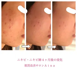 セミロング ヘアアレンジ キッズ ネイル マツエク・マツパ ニキビ跡専門サロン Ainaのエステ・リラクイメージ