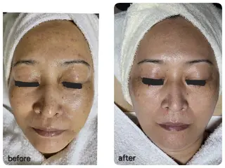 ニキビ・ニキビ跡専門 レゾン京橋店　のエステ・リラクイメージ