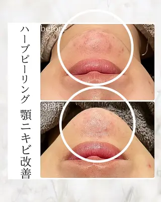 bellissimo 【ベリッシモ】所属・ちひろ　痩身/ハーブ bellissimoのエステ・リラクイメージ