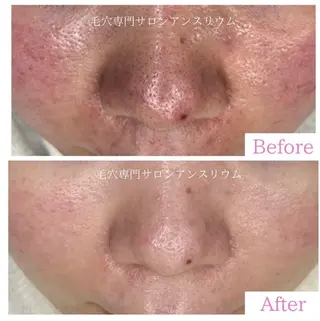 毛穴ケア専門サロンアンスリウム所属・茨城土浦 つくば毛穴 ケア専門サロンのエステ・リラクイメージ