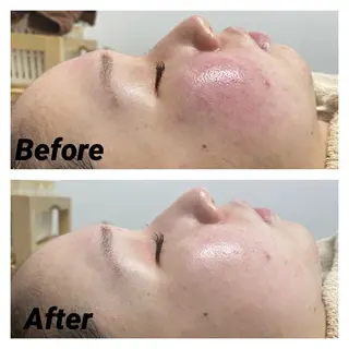 【赤ニキビ改善】 BELL'ET新宿店のエステ・リラクイメージ