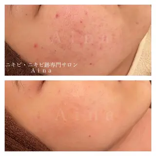 カラー パーマ ヘアアレンジ メンズ キッズ ネイル マツエク・マツパ アイブロウ ニキビ跡専門サロン Ainaのエステ・リラクイメージ