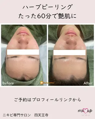 Meupニキビ専門店 背中/ハーブ/肌管理のその他イメージ