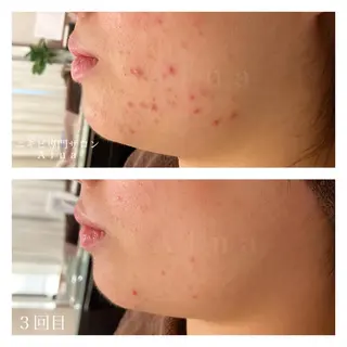 ミディアム カラー パーマ ヘアアレンジ メンズ キッズ マツエク・マツパ ニキビ跡専門サロン Ainaのエステ・リラクイメージ