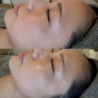 ニキビ・毛穴改善 🌿ハーブピーリングのエステ・リラクイメージ