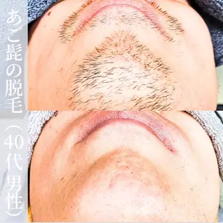 メンズ 【一本ずつ脱毛】 ReMove 柏のエステ・リラクイメージ