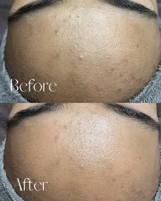 シミ🩷ニキビ専門店 Matteo🎀✨のエステ・リラクイメージ