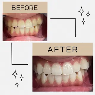 セルフホワイトニング 都立大学🦷✴︎のその他イメージ