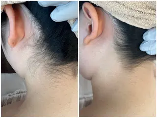 キッズ 全身脱毛/韓国ツヤ肌 ハーブピーリングのエステ・リラクイメージ