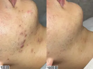 ピーリング×肌質管理 &meのエステ・リラクイメージ