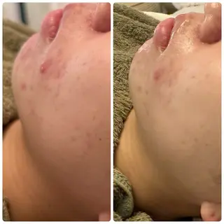 ニキビ・毛穴改善 🌿ハーブピーリングのエステ・リラクイメージ