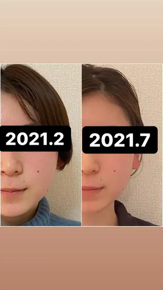 美容鍼WINBACK サロンRemeのエステ・リラクイメージ