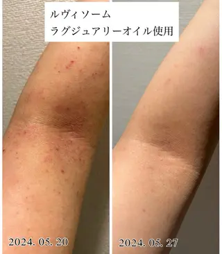 ハーブピーリング専門 毛穴洗浄❤️眉waxのエステ・リラクイメージ