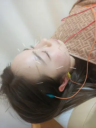 リフトアップ・たるみ ☆美容鍼小顔矯正のその他イメージ