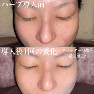 ロング カラー パーマ ヘアアレンジ メンズ キッズ ネイル マツエク・マツパ アイブロウ 即小顔♥️美容鍼× ハーブピーリングのその他イメージ