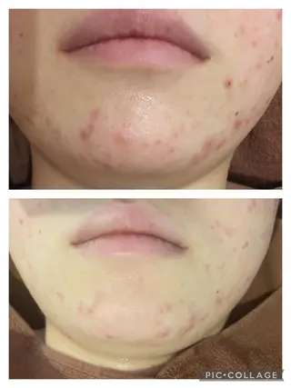 セミロング カラー パーマ ヘアアレンジ メンズ キッズ ネイル マツエク・マツパ アイブロウ 3か月で肌革命👼 ニキビ専門店💫のエステ・リラクイメージ